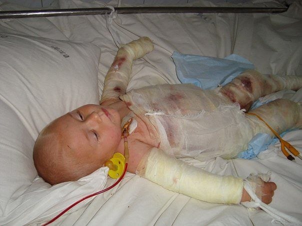 Новость - События - Помогите спасти жизнь: малыш упал в ведро с кипятком