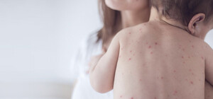 На Буковині у трирічної дитини виявили кір: лікарі б'ють на сполох через можливий спалах