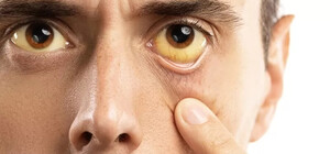 В Запорізькій області зареєстрували випадки захворювання на Гепатит А