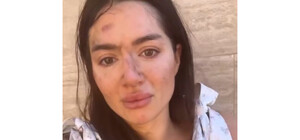 Упала зі схилу, тікаючи від збоченця: в Одесі дівчину намагався зґвалтувати незнайомець