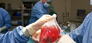 Трансплантация органов в Запорожье: быть или не быть?