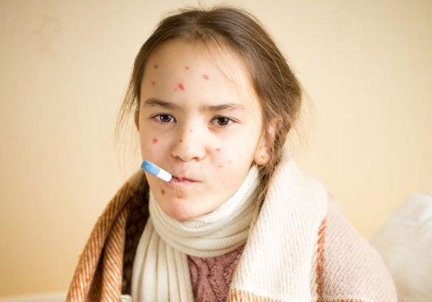 Новость - События - Своди ребенка на прививку: в Запорожской области фиксируют новые случаи заражения корью