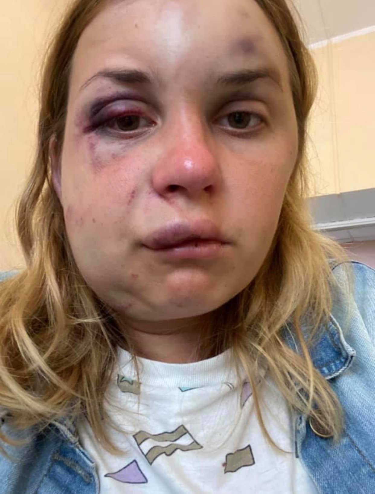 У пострадавшей серьезные повреждения на лице, перелом челюсти / фото: fb Антон Геращенко