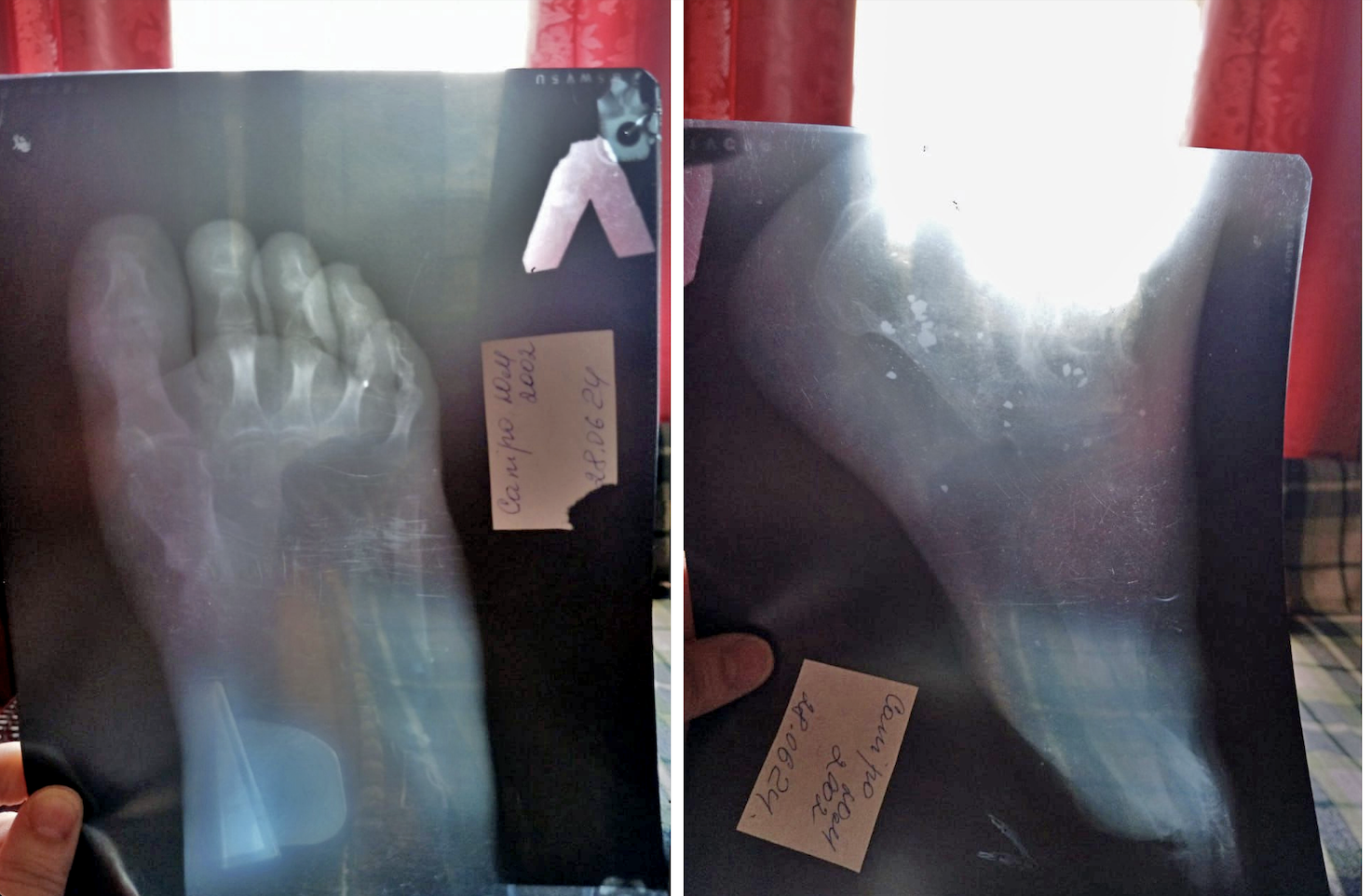 Белые пятнышки – это обломки - фото предоставила мама Юрия