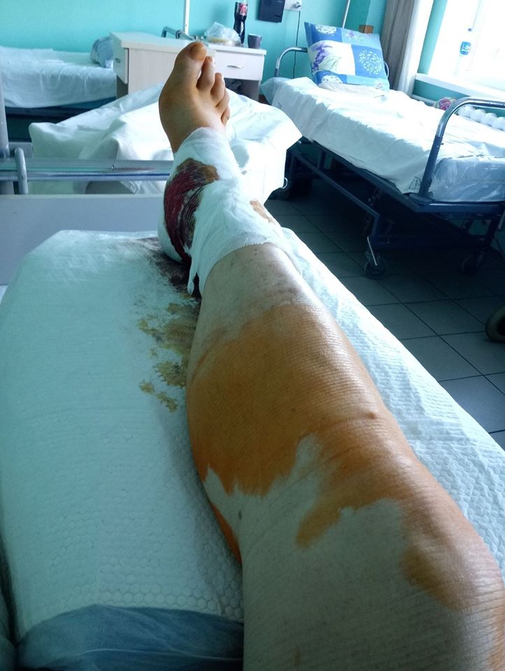 У второго мужчины перелом ноги в трех местах. Фото: fb Сергей Барбашин