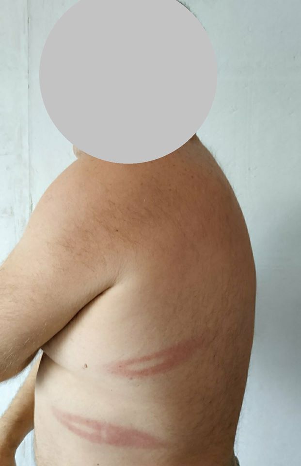 У мужчины ушиб грудной клетки. Фото: fb Сергей Барбашин