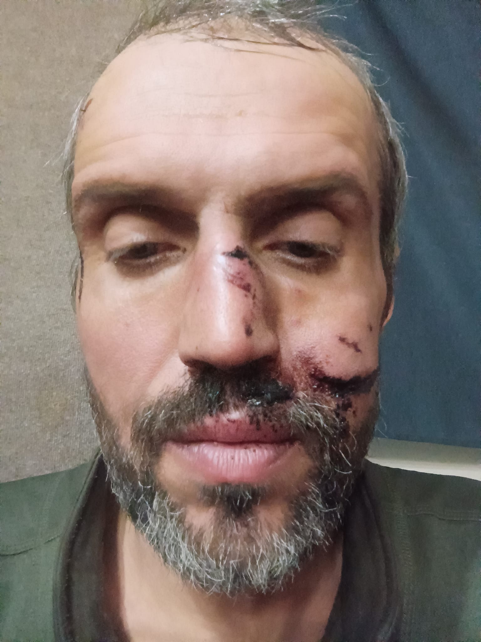 Запорізький журналіст вижив після оточення РФ в Ахмат лісі.