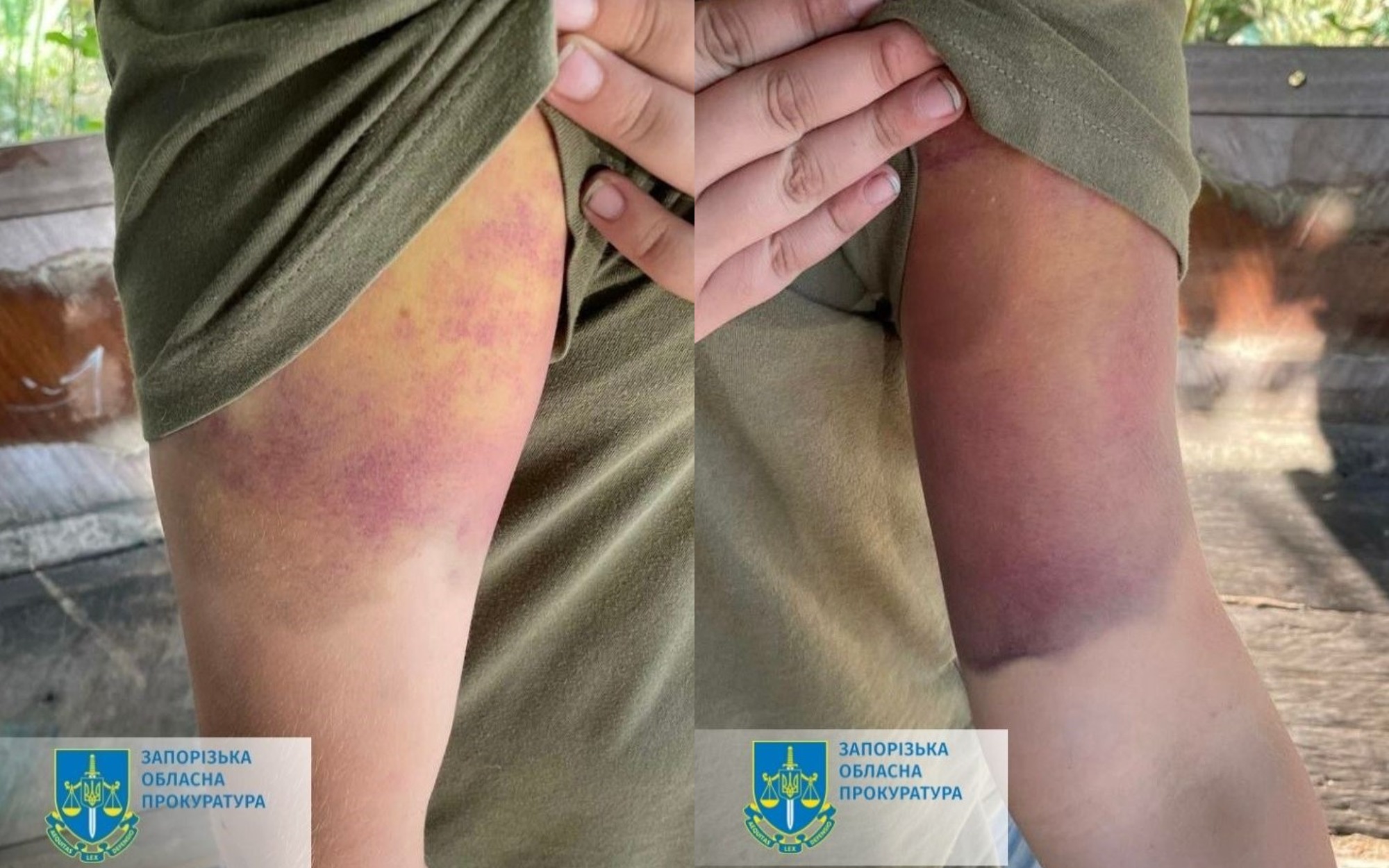 У Запоріжжі мати побила свого сина так, що хлопчик потрапив до лікарні.