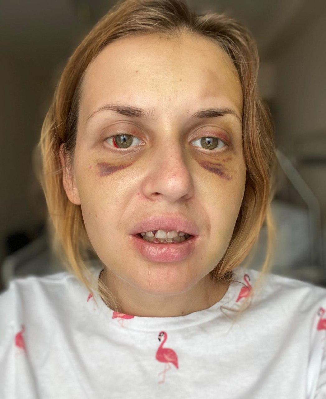 Насте сняли шинировку с челюсти и выписали домой. Фото: @nastyalugova