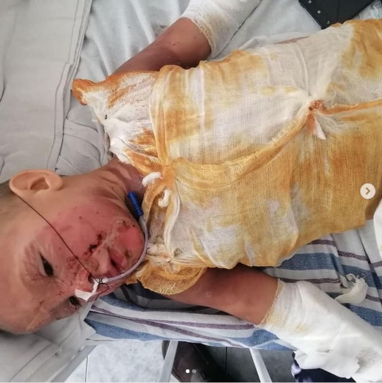 6-летний Максим нуждается в пересадке кожи. Фото: @bf_emotion