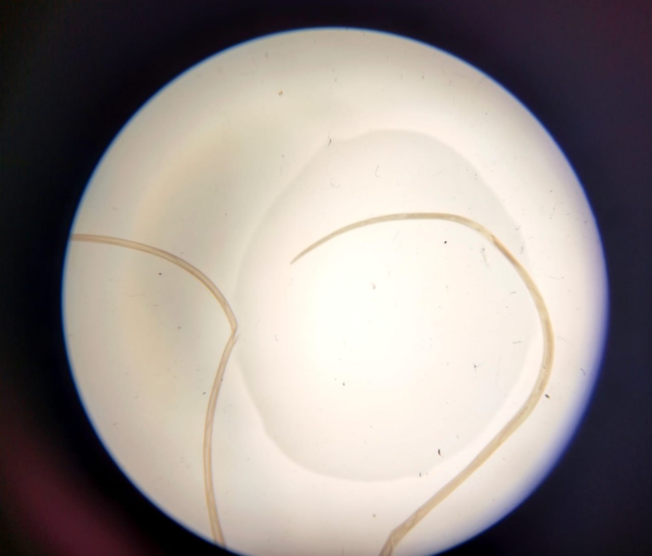 У мешканки Запоріжжя лікарі виявили під шкірою жахливого паразита.