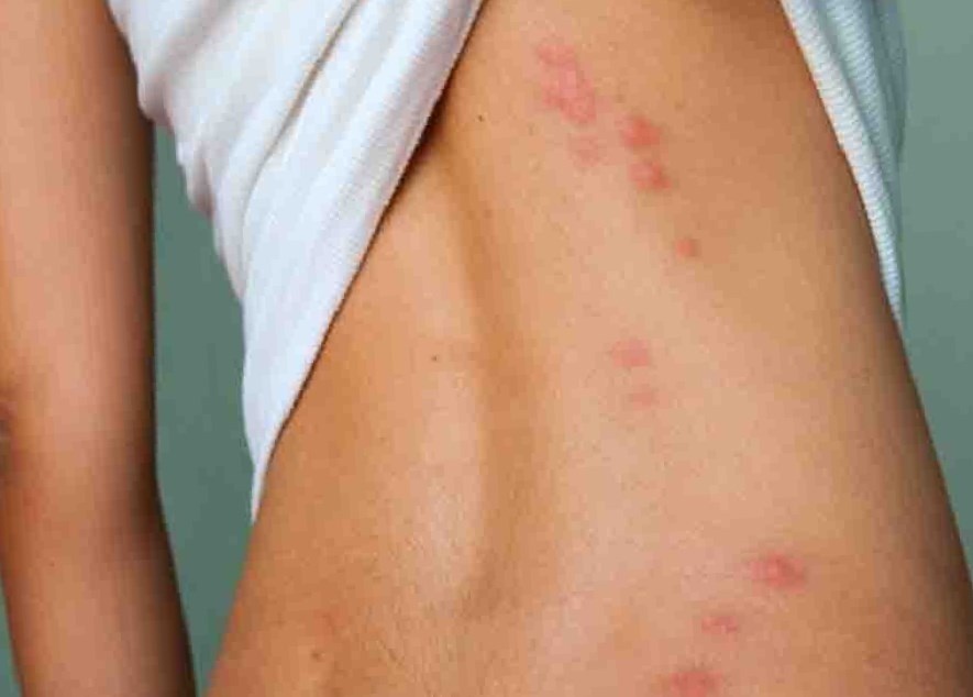 Укус сколопендры - фото: primorka.city